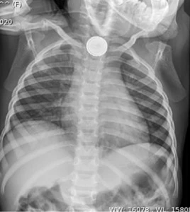 Prevention of Injuries from Button Battery Ingestion in Children | AAO ...