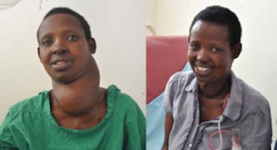 Lilane before and after her thyroid lobectomy.