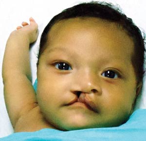 Honduran boy waits for primary repair of his cleft lip.
