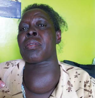 This patient presented with a long-standing goiter, desiring thyroidectomy. She underwent successful subtotal thyroidectomy, with preservation of approximately 20-25 grams of thyroid tissue in an attempt to avoid postoperative hypothyroidism.