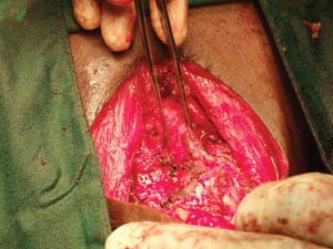 This intraoperative photo displays the severe amount of tracheal compression found in a patient with an aggressive thyroid malignancy that developed in the setting of a recurrent goiter. She ultimately required tracheostomy for airway protection.