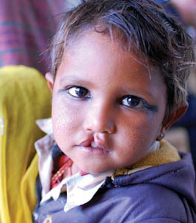 A team from Medical Missions for Children traveled to India in January to help children with clefts. The team performed 18 total surgeries, including 16 cleft-lip repairs.