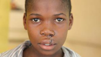 Zimbabwean boy patient, post-op.