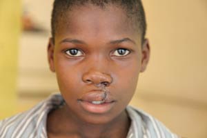 Zimbabwean boy patient, post-op.