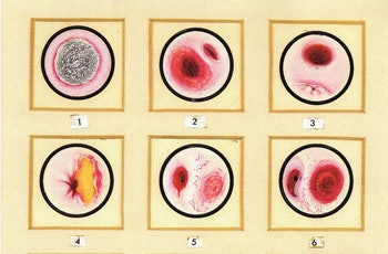 Endoscopic views as sketched by Chevalier Jackson: 1) Zenker’s diverticulum with food bolus; 2) Zenker’s diverticulum following endoscopic removal of the food bolus; and 3) esophagus following diverticulectomy. (Reprinted from Bronchoesophagology and endoscopic plates illustrated by Chevalier Jackson.)