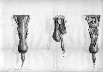 First known published drawings of Zenker’s diverticulum from an autopsy performed by Mr. Abraham Ludlow, surgeon, at Bristol, England in 1764. A) Anterior; B) lateral; and C) open anterior views. (Reproduced with permission from the Institute of the History of Medicine, Johns Hopkins University.)