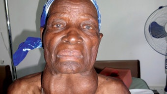 Preoperative photo of a 72-year-old woman with a goiter for more than 30 years.