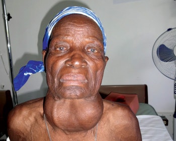 Preoperative photo of a 72-year-old woman with a goiter for more than 30 years.
