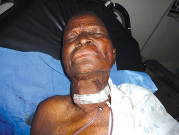 Postoperative photo after hemithyroidectomy. Her thyroid was so large that her carotid was adherent to the capsule and her internal jugular vein had little to no flow.