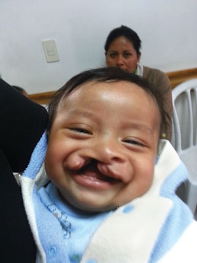 A cleft lip doesn’t stop this child’s brightness from shining through.