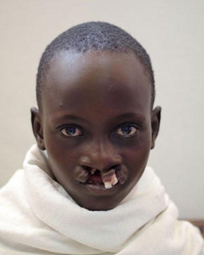 Photograph of a teenage girl psychologically and socially burdened with disfiguring bilateral cleft lip.
