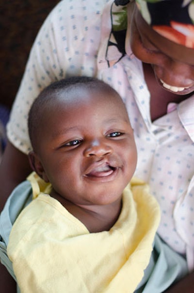 Photograph of a mother and her infant son who has an incomplete cleft lip.