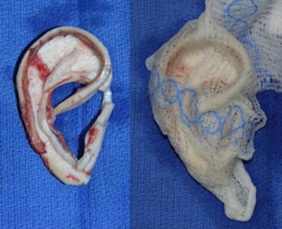 Cartilaginous framework for stage 1 Nagata microtia repair.