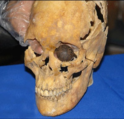 Eye prosthesis found in Shahr-i-Sokhta, southeast Iran.