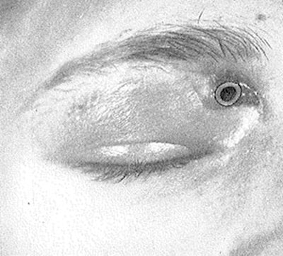 Frontal sinus trephination.
