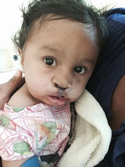13-month-old Santos in mom’s arms on postoperative day one following bilateral cleft lip repair.