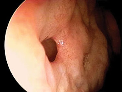Yanigisawa Image Library: Telescopic view (4mm, 0˚) shows a perforation of the nasal septum in its anterior inferior portion.