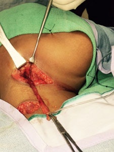 Second branchial cleft fistula tract in an 11-year-old male.