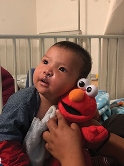 A young patient following the repair of a unilateral cleft lip