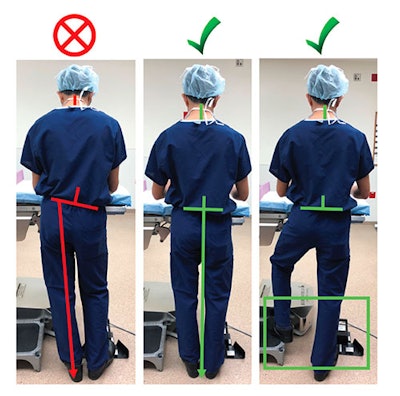 Figure 2. Left: Bad posture posterior view: asymmetrical weight bearing is evident by tilted pelvic line and non-vertical alignment of lumbar spine. Middle: Good posture without step stool. Lines demonstrate neutral lumbar and pelvic alignment. Right: Good posture with step stool.