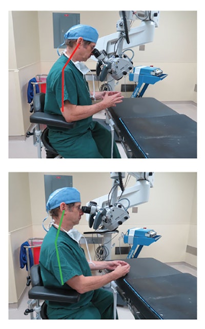 Figure 3. Top: Microscope height placed too low and with downward angled eyepieces, requires the surgeon to flex the neck. Bottom: Eyepiecesoriented with only slight declination allows the surgeon to operate with the head in a more upright neutral neck position.