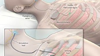 UpperAirwayStimulation