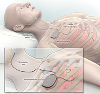 Figure 1. Hypoglossal nerve stimulator. © Inspire Medical Systems, Inc. Image used by permission.