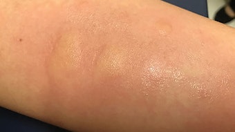 SkinPrick