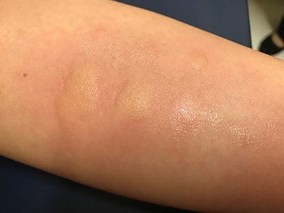 Figure 1. Wheal responses seen after skin prick testing.