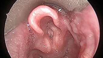Esophagitis