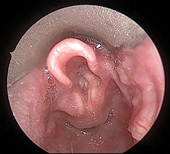 Esophagitis E1593527009118