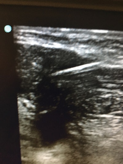 Figure 2: Photo of an ultrasound needle aspiration of a plunging ranula.