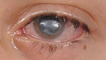 Corneal1