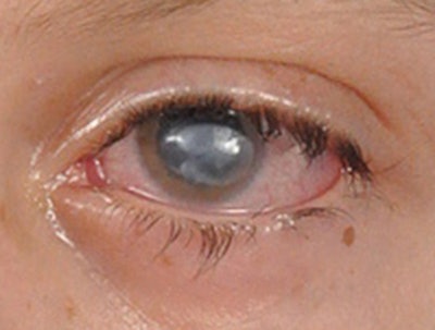 Figure 1. Neurotrophic keratitis. Severe corneal opacification is demonstrated in a patient with combined facial paralysis and trigeminal anesthesia following extirpation of a large vestibular schwannoma.