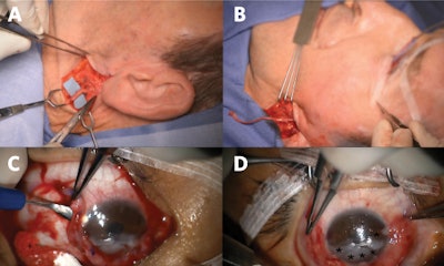 Figure 2. Great auricular nerve transfer for corneal neurotization. (A) Anterior and posterior branches of the great auricular nerve are identified. (B) A sural nerve autograft is harvested and inset between the great auricular nerve and inferior fornix. (C) Tunnels are made into the corneal stroma (C), and (D) nerve fascicles (*) positioned about the limbus to restore corneal sensory input.
