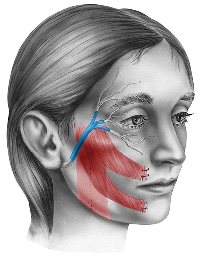 Facial Reinnervation