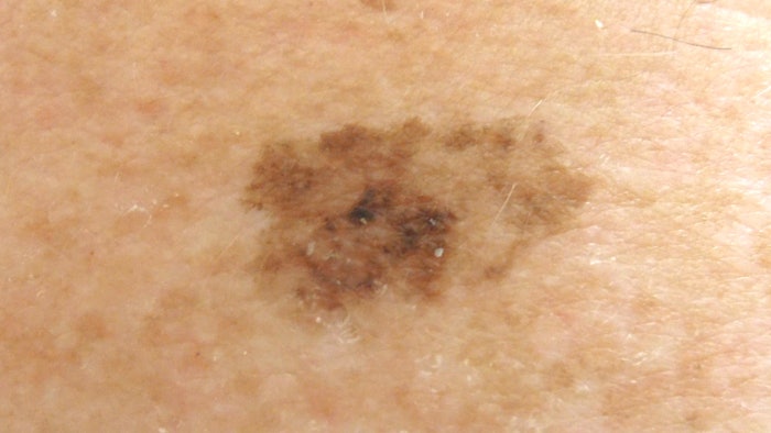 D1 Early Stage Melanoma Pic Clinical