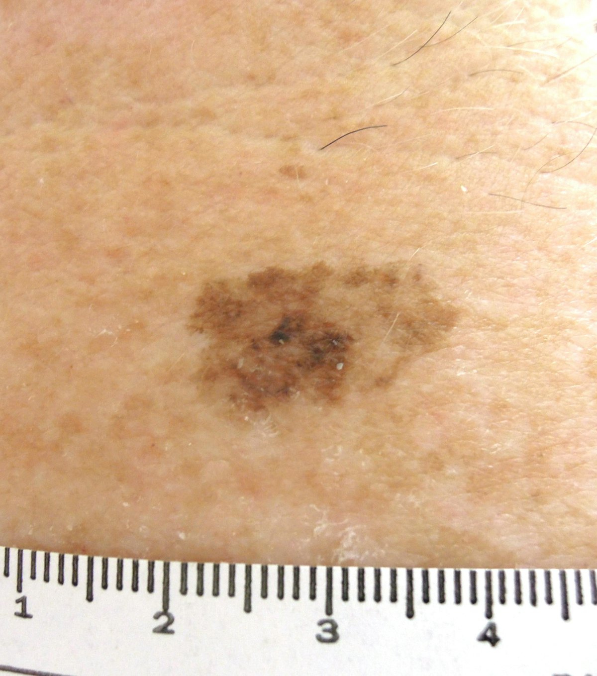 Whats New In Early Stage Melanoma Aad