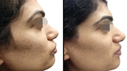 D2 Prp Acne Scars Photo