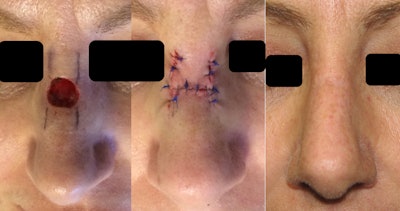 健康・医学 Local Flaps in Facial Reconstruction Local Flaps in Facial Reconstruction: 9780323683906