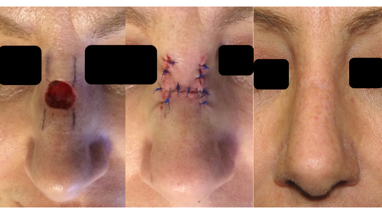 Nasal Reconstruction | AAO-HNS Bulletin Nasal Reconstruction | AAO-HNS Bulletin