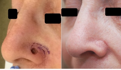 Nasal Reconstruction | AAO-HNS Bulletin