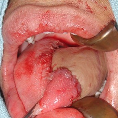 Figure 1a. Lateral tongue defect reconstructed with a radial forearm free flap.