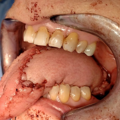 Figure 1b. Comparable defect with a submental island flap.
