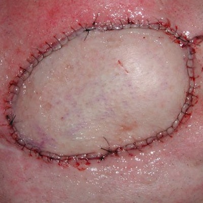 Figure 2. Facial defect reconstructed with a radial forearm free flap.