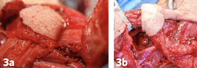 Figure 3a and 3b. Laryngopharyngeal defects closed with the supraclavicular artery island flap.