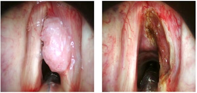 Figure 1. Pre- and postoperative photographs of patient who underwent TOLMS. Photos courtesy of Marc Remacle, MD, PhD.