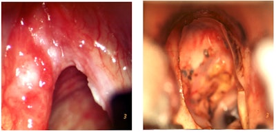 Figure 2. Before (right) and after (left) photos of tumor peeled off the inner thyroid cartilage down to the infraglottis. Photos courtesy of Marc Remacle, MD, PhD.