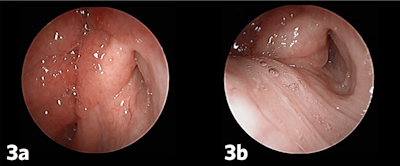 Figure 3. 45-degree transnasal endoscopic view of left Eustachian tube with moderate inflammation/ compromise of opening of the valve, Grade 3 (a) resting position and (b) open position.