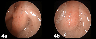 Figure 4. 45-degree transnasal endoscopic view of left Eustachian tube with moderate inflammation/anterior thrusting of the torus tubarius that prevents opening of the valve, Grade 4 (a) resting position and (b) open position.